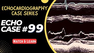 ECHO CASE 99  Echocardiography for Beginners  M Mode Echocardiogram [upl. by Itnahsa]