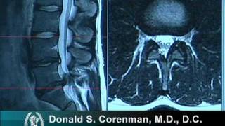 How to Read a MRI of a Lumbar Herniated Disc  Lower Back Pain  Colorado Spine Surgeon [upl. by Clapp210]