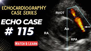 ECHO CASE 115  Echocardiography Spot Diagnosis Case Series [upl. by Angle]