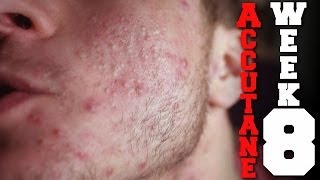 Joints Depression and Lifting on Accutane Week 8 [upl. by Atirahc]