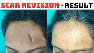 quotScar Perfect Ultimate Surgical Transformationquot quotScar Surgery Success Storyquot Result aft 30 days [upl. by Arianne]