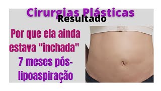 Cirurgias plasticas resultados por que após 7 meses da lipoaspiração ela ainda estava inchada [upl. by Ansev]