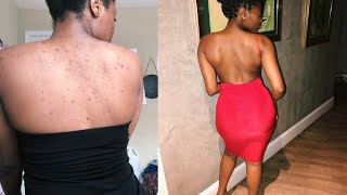 HOW I CLEARED MY BACK ACNE [upl. by Ydnolem]