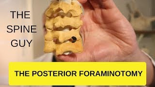 CERVICAL STENOSIS RADICULOPATHY  PART 4  THE POSTERIOR FORAMINOTOMY [upl. by Batholomew]