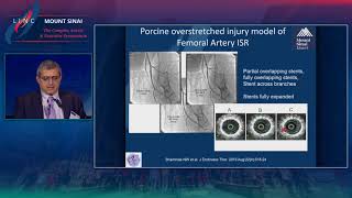 Atherectomy for Restenosis Future of Combination Therapy [upl. by Roede]