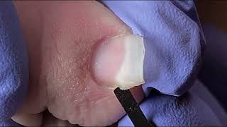 Ingrown Toenail Removal  Pedicure Treatment and Very Satisfying  Best Satisfying Nail Cutting [upl. by Owades]