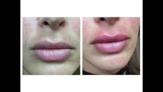 Juvederm Lips by Anusha in West LA [upl. by Menashem]