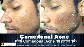 Comedonal Acne  Balck head  White head treatment पिंपल  कील  मुहाँसे का इलाज  Dr Uttam Lenka [upl. by May]