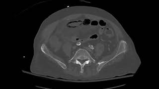 Pneumatosis intestinalis and portal venous gas [upl. by Hey]