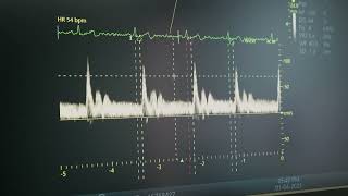 R700 Elevating Ultrasound Efficiency with lucid Vision mp4 [upl. by Nabois]