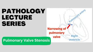 Pulmonary Valve Stenosis  Pathology Lecture Series  Lecture 17 [upl. by Walburga]