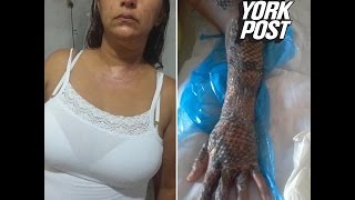 Fish scales heal womans burned body [upl. by Ecirp]