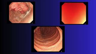 Gastric giant polyp  Todua Clinic [upl. by Latreshia708]