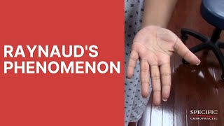 Raynauds Syndrome Phenomenon HELPED by Dr Suh Gonstead Chiropractic NYC [upl. by Sanjay376]