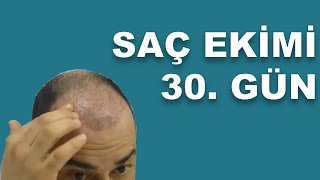 Saç ekimi  Şok dükülme 30 gün [upl. by Neo]