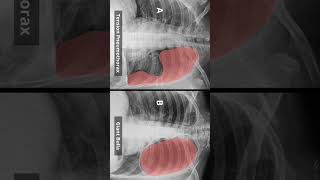 CXR Bulla Vs Pneumothorax [upl. by Maiah]