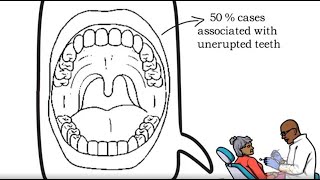 Calcifying Epithelial Odontogenic Tumor CEOT [upl. by Arny251]