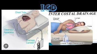 intercostal drainagerecurrent plueral effusionmbbsprocedure medicose Sudarshanlipane17 ⛑️⛑️🩺 [upl. by Arlyn]