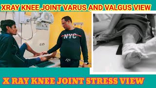 X RAY KNEE JOINT STRESS VIEW VALGUS AND VARUS PROJECTION [upl. by Schrick337]