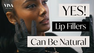 Natural Lip Filler Procedure 👄 Before amp After of Subtle and Delicate Lip Modification [upl. by Heigl529]