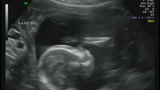 Ultrasound of Identical Twin Boys at 19 weeks [upl. by Arihsat]