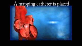 Ventricular Tachycardia VT Ablation [upl. by Olimac]