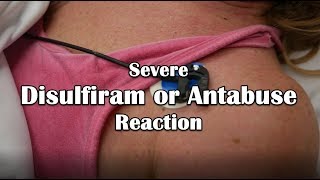 Disulfiram or Antabuse Reaction Emergency [upl. by Aniretac]