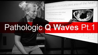 Q Wave Pathology Pt1 [upl. by Oicangi]