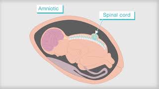 What is Spina Bifida [upl. by Aeniah356]