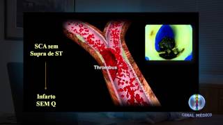 Infarto Agudo no Miocárdio  Fisiopatologia I 210 [upl. by Tinya502]