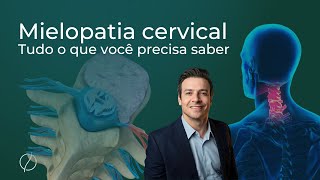 Mielopatia cervical sintomas e cirurgia [upl. by Eiclehc]