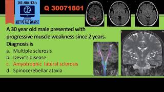 Amyotrophic lateral sclerosis [upl. by Elwyn]