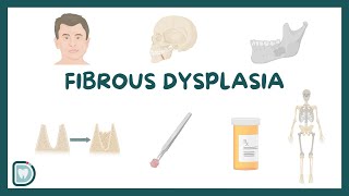 Understanding Fibrous Dysplasia Causes Diagnosis Types and Management [upl. by Reidar]