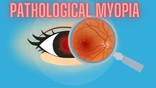 Pathological Myopia  High Myopia  Ophthalmology Lecture [upl. by Eiramannod]