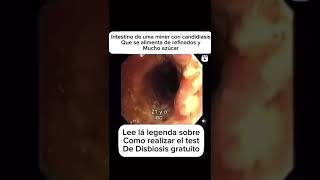 Intestino con inflamación crónica parásitos pólipos y disbiosis [upl. by Johann104]