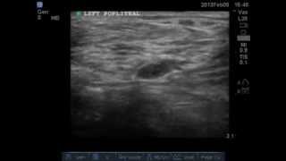 Ultrasound compression test for DVT Left Popliteal Vein Normal [upl. by Arikahc]