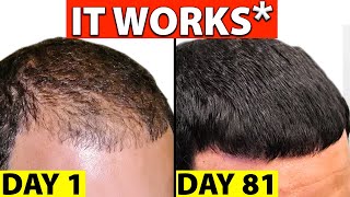 The Truth About Finasteride Propecia for Hair Loss [upl. by Humph822]