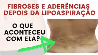 Tratamento para Fibroses e Aderências depois da lipoaspiração entenda o que aconteceu com ela [upl. by Kappenne500]