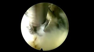 Ernia del disco L4L5 intervento endoscopico mininvasivo NSA Neurochirurgia [upl. by Donnell]