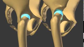 subluxation hip dysplasia developmental neo acetabulum build [upl. by Anawd191]