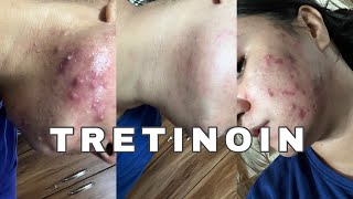 Tretinoin Ruined My SKIN BARIER 🥲 [upl. by Wojcik]