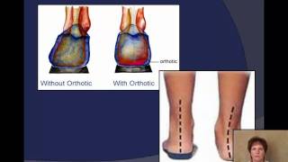 Plantar Fasciitis explained by a Podiatrist [upl. by Yrrot727]