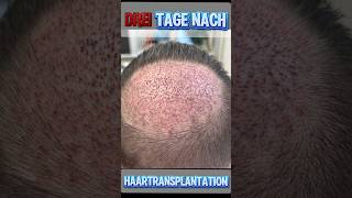 Haartransplantation hair haartransplantation haare beauty [upl. by Azilanna570]