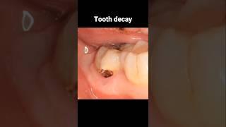 Filling tooth decay process dentistry dentist filling tooth [upl. by Ailito822]