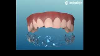 Invisalign simulazione [upl. by Bogie561]