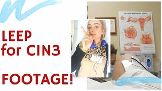 LEEP Procedure for CIN 3HSIL  Prep LIVE Footage amp Advice [upl. by Mab494]