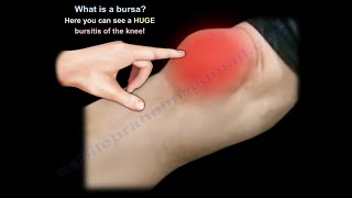 What Is BURSITIS  Everything You Need To Know  Dr Nabil Ebraheim [upl. by Maag676]