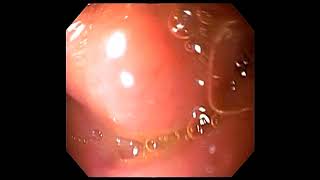 Normal oesophagogastroscopyDuodenitis withduodenal ulcer [upl. by Nitsoj]