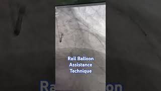 Rail Balloon Assistance Technique interventional cardiology cardiologyfellow angioplasty [upl. by Eniledam355]