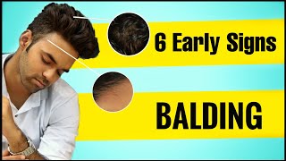 6 EARLY STAGES OF BALDING Will You Go Bald Male Pattern Baldness [upl. by Ymarej]